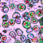 nearly-800-cases-in-south-carolina’s-record-breaking-measles-outbreak